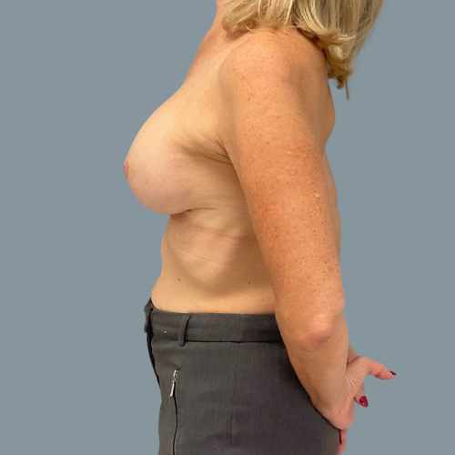 After breast augmentation side view