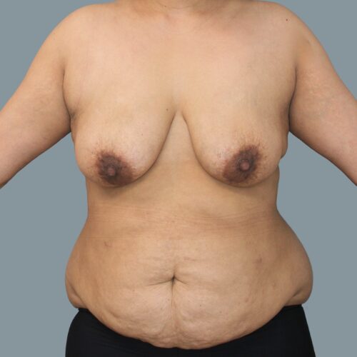 Before Image of Circumferential Lipectomy & Mastopexy