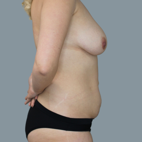 Before image of an abdominoplasty and mastopexy with fat grafting