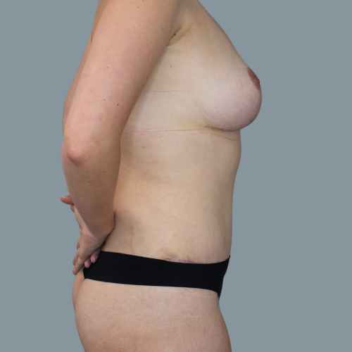 After image of an abdominoplasty and mastopexy with fat grafting