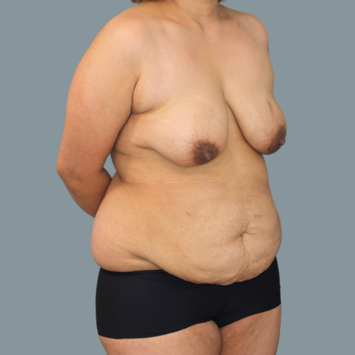 Before Image of Circumferential Lipectomy & Mastopexy