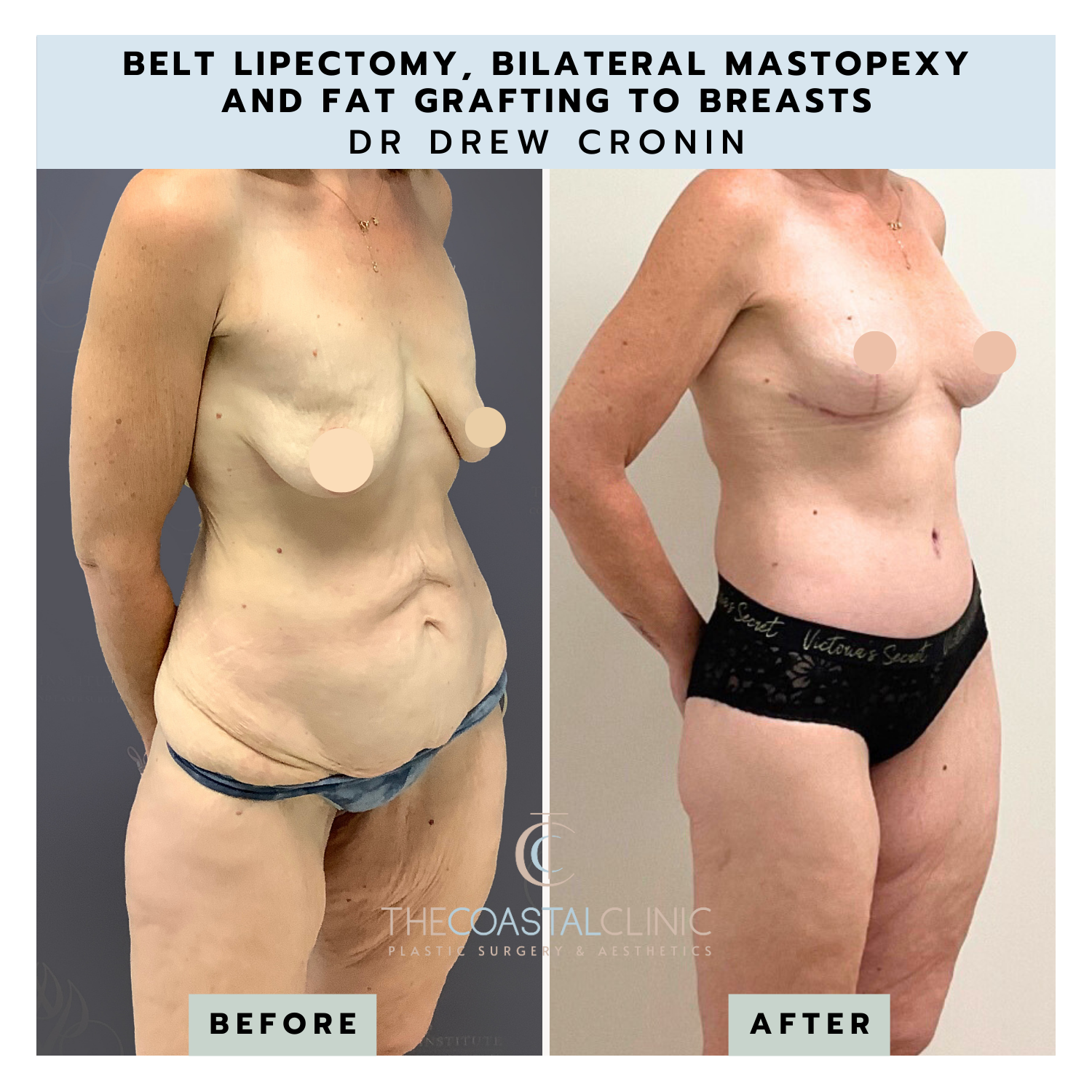 Belt Lipectomy Before & After, Case 3