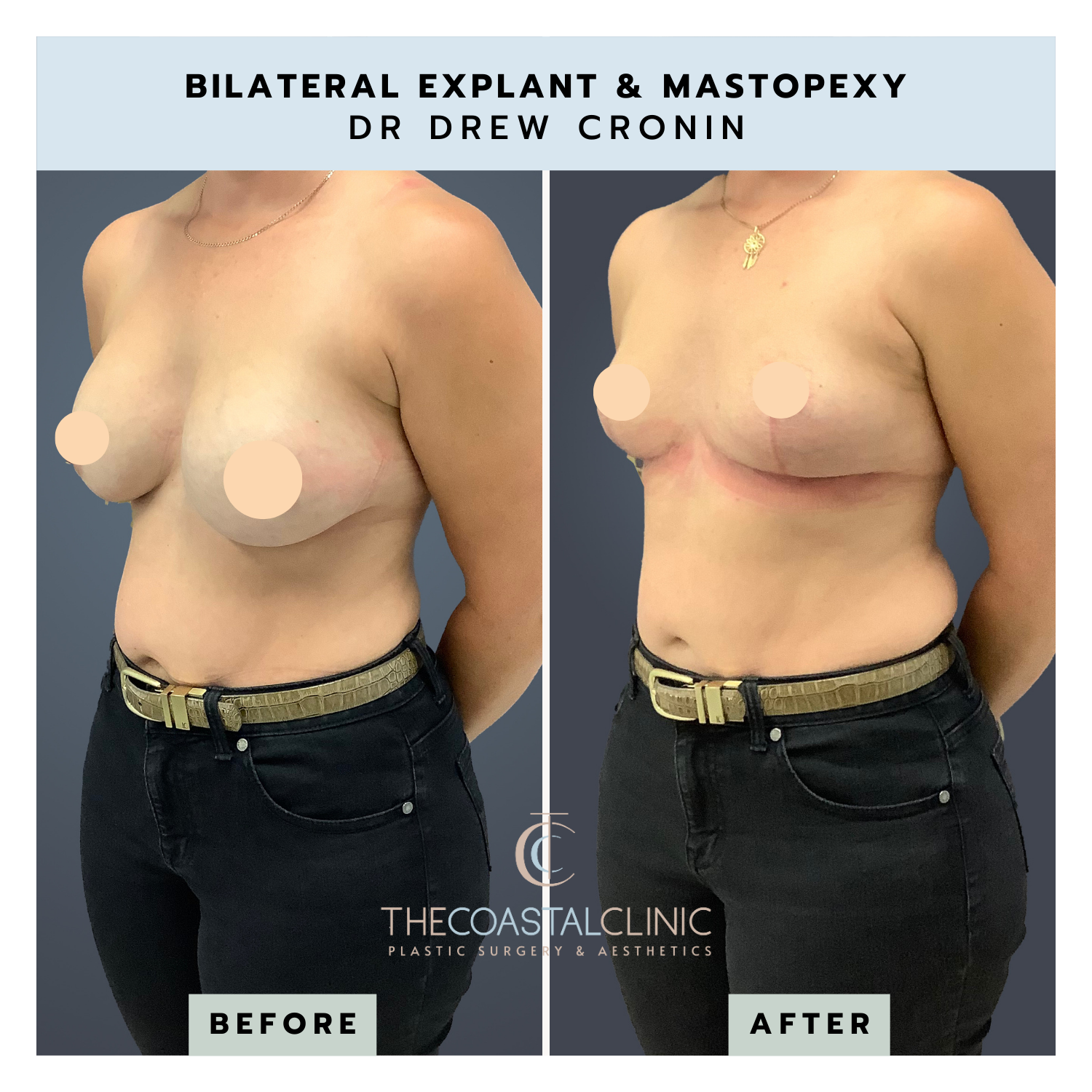 Bilateral Explant - The Coastal Clinic Plastic Surgery and Aesthetics Gold  Coast