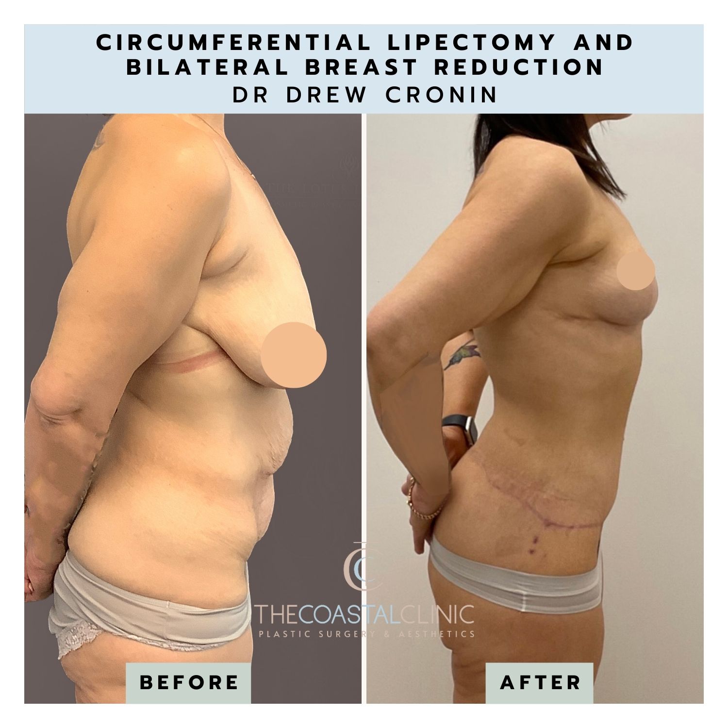 Mammoplasty (Breast Reduction) - The Coastal Clinic Plastic Surgery and  Aesthetics Gold Coast