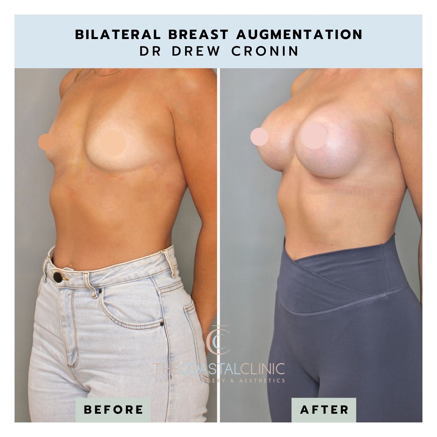 Teardrop Breast Implants  Gold Coast Plastic Surgery