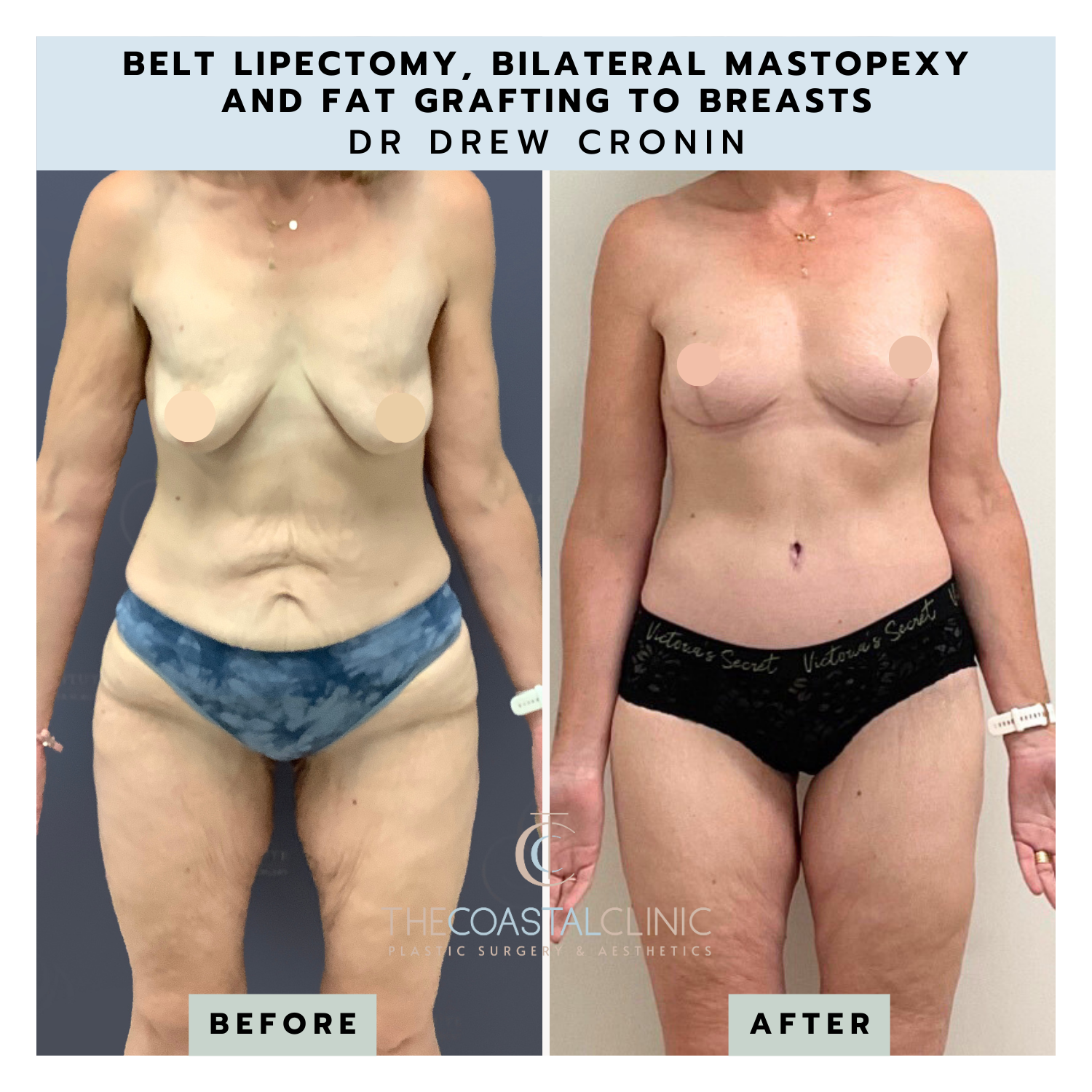 Belt lipectomy with lipo, 4 weeks post-op : r/tummytucksurgery