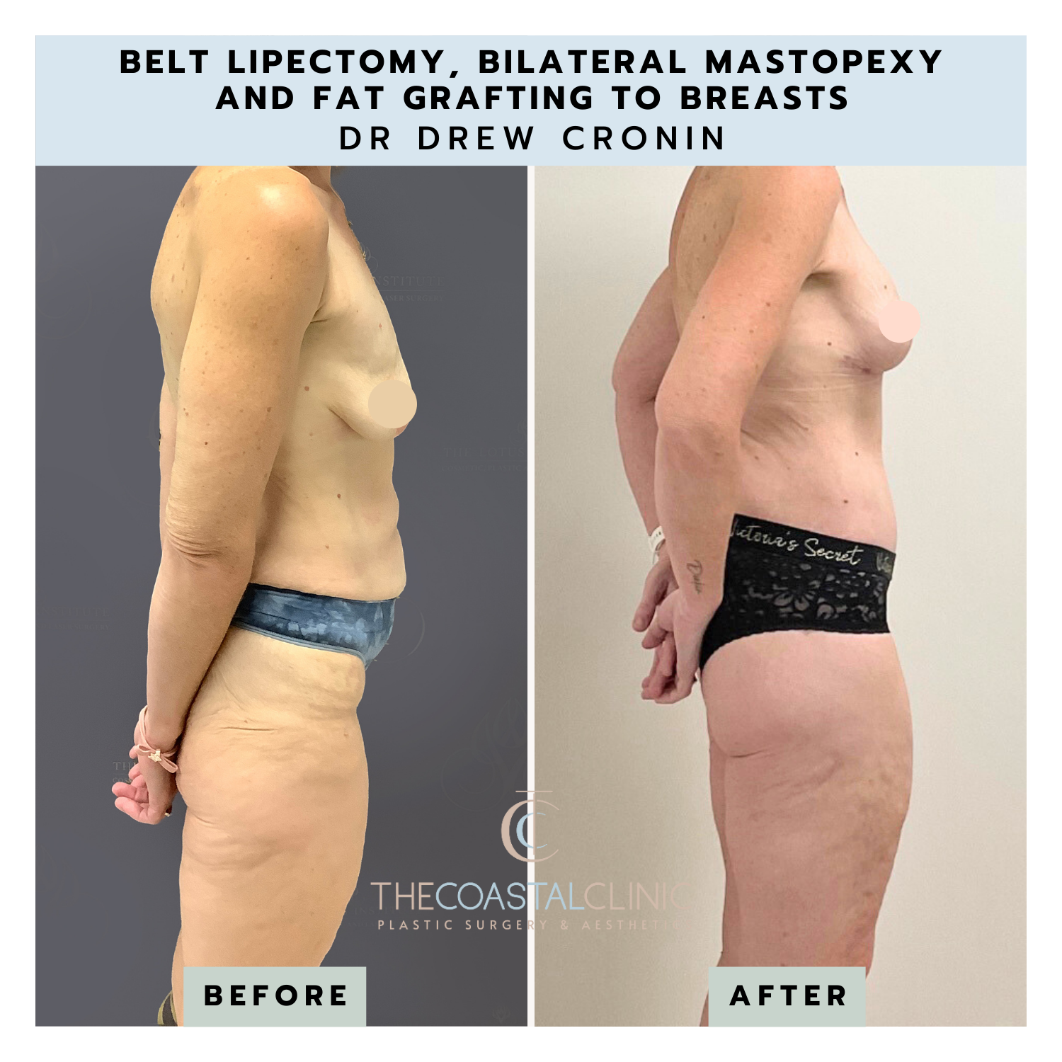 Belt Lipectomy (Removal of Excess Skin Folds Around Your Waist)