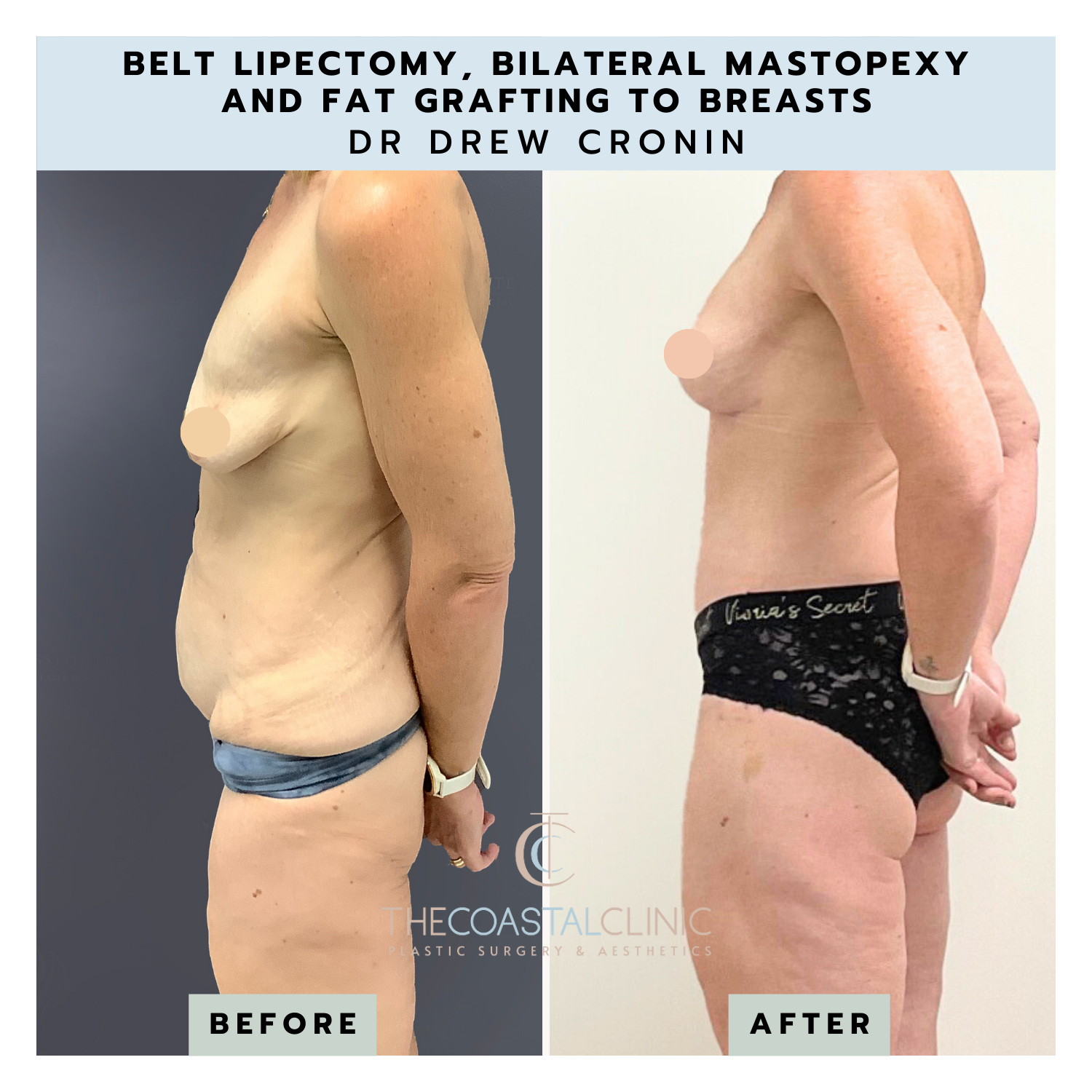 Belt Lipectomy (Removal of Excess Skin Folds Around Your Waist