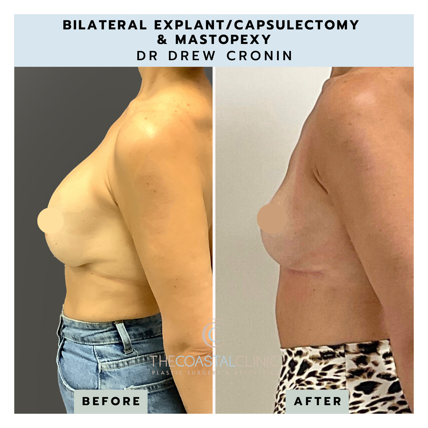 Bilateral Explant - The Coastal Clinic Plastic Surgery and