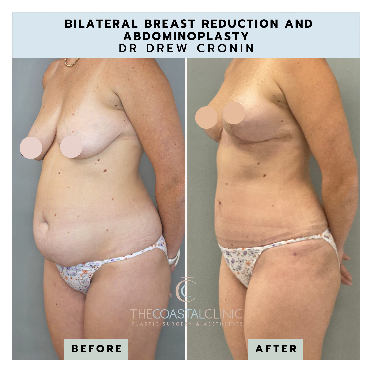 Breast reduction before and after in Australia.