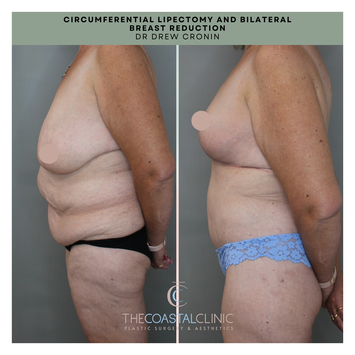 Circumferential Body Lift Case #64893 - The Plastic Surgery Group